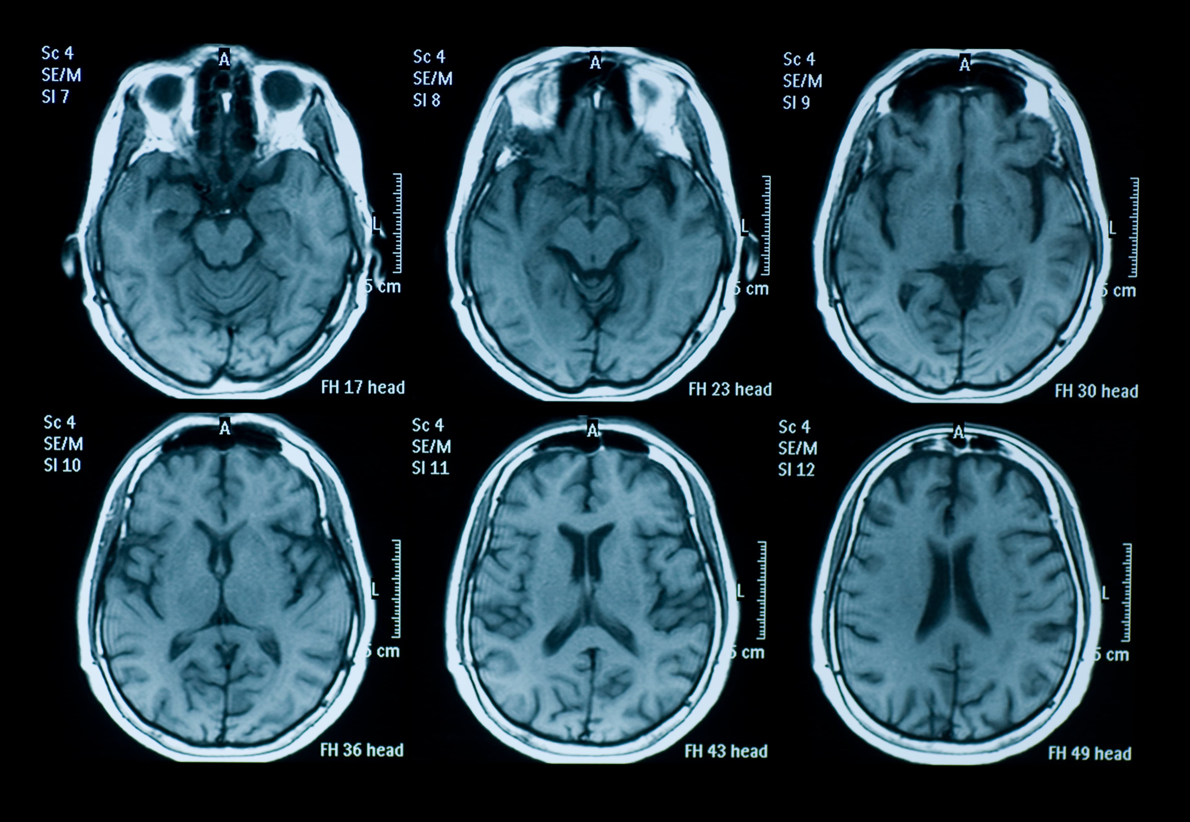 fMRI scan